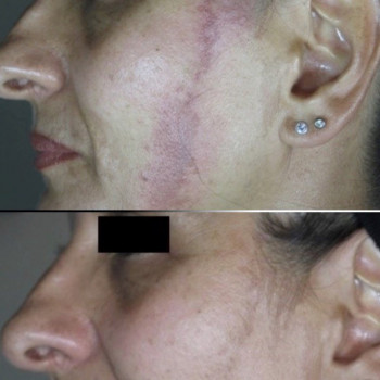 IPL терапія - видалення пігментації
                    Косметологический центр VitaLine Киев