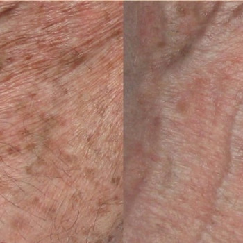 IPL терапія - видалення пігментації
                    Косметологический центр VitaLine Киев