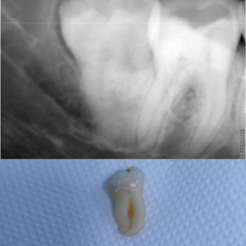 Удаление зуба мудрости