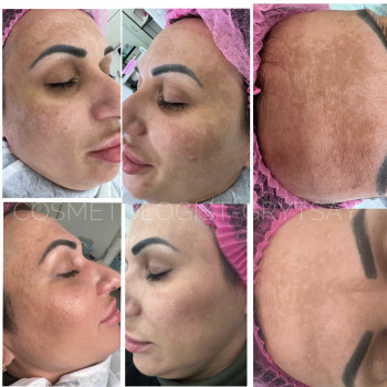 Корекція пігментаціі #
Фото до та після 2 процедури