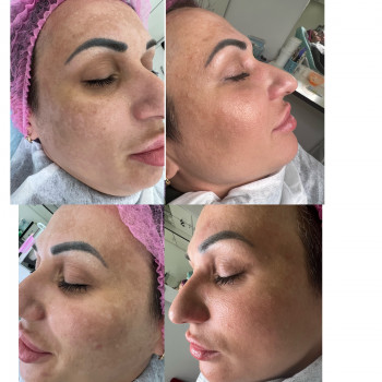 Корекція пігментаціі #