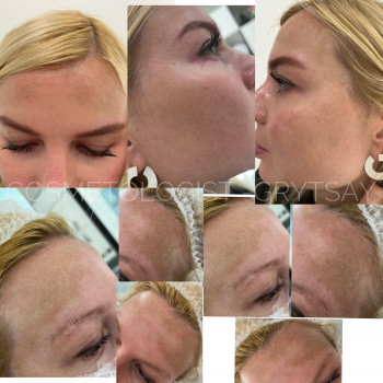 Комплексна робота з пігментацією #