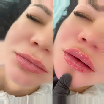 Збільшення губ
                    Косметолог-инъекционист Наталья Днепр