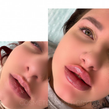 Збільшення губ
                    Косметолог-инъекционист Наталья Днепр