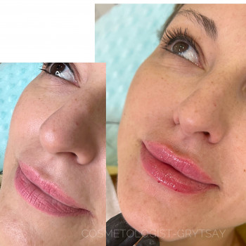 Збільшення губ
                    Косметолог-инъекционист Наталья Днепр