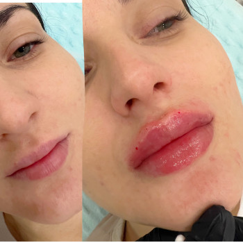   пластика губ