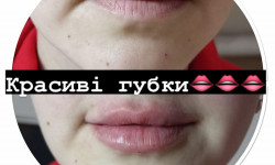Контурна пластика губ Косметолог-инъекционист Светлана Киев