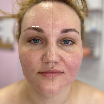 Буккальный и лифтинговый массаж лица
                    Салон красоты Sweet Skin Киев