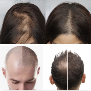 SMP - мікропігментація шкіри голови (медичне татуювання) - тріхопігментація
                    Тату мастер Лариса Львов