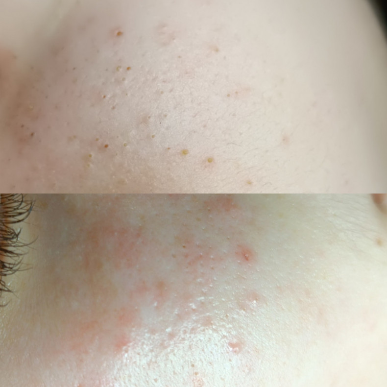 Чистка лица Комби, фото - Косметолог Марина Шугай