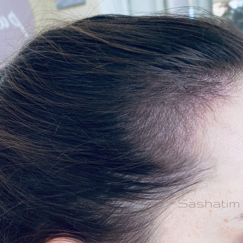 Тріхопігментація -імітація росту волосся.