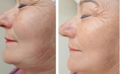 Масаж обличчя вакуумний рф Салон красоты Slim Line Белая Церковь