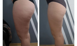 Вакуумний масаж Салон краси Slim Line Біла Церква
