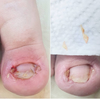 Резекция вросшего ногтя
                    Подолог Руслана Петровна Одеса