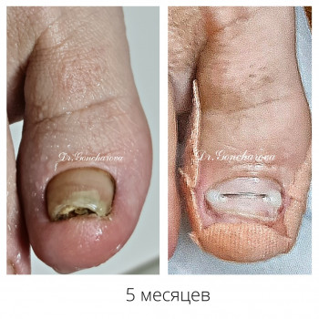 Лечение грибка ногтей
                    Подолог Руслана Петровна Одесса