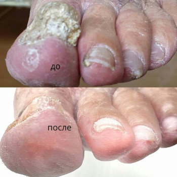Обработка онихогрифоз
                    Подолог Руслана Петровна Одесса