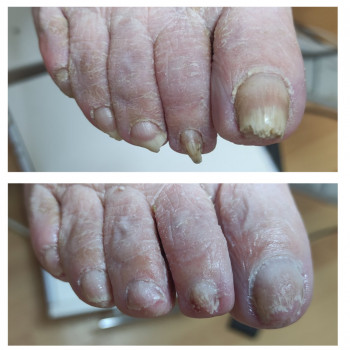 Обработка онихогрифоз
                    Подолог Руслана Петровна Одесса