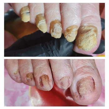 Обработка онихогрифоз
                    Подолог Руслана Петровна Одесса