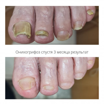 Обработка онихогрифоз
                    Подолог Руслана Петровна Одесса
