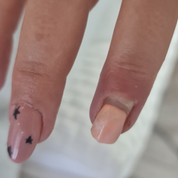 Лечение паронихии
                    Подолог Руслана Петровна Одеса