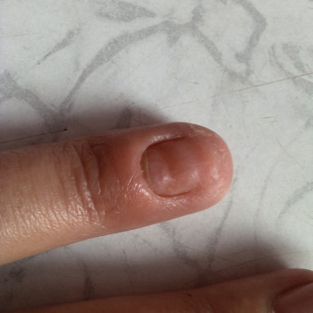 Лечение панариция
                    Подолог Руслана Петровна Одесса