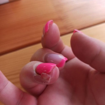 Лечение панариция
                    Подолог Руслана Петровна Одесса