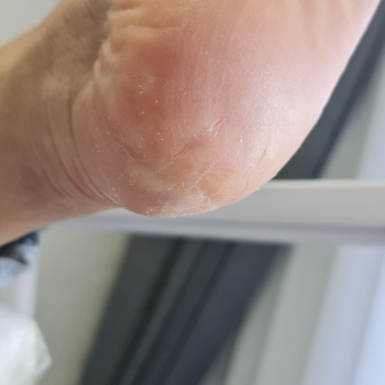 Педикюр аппаратный
                    Подолог Руслана Петровна Одесса