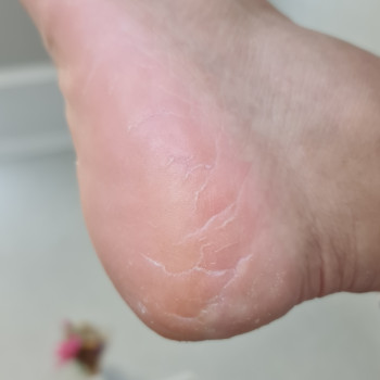 Педикюр аппаратный
                    Подолог Руслана Петровна Одесса