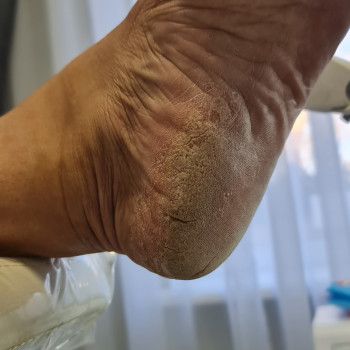 Педикюр аппаратный
                    Подолог Руслана Петровна Одесса