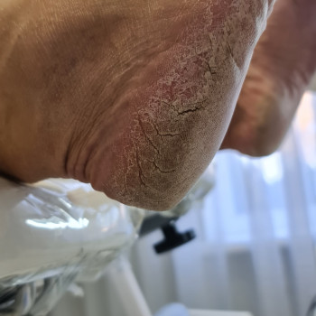 Педикюр аппаратный
                    Подолог Руслана Петровна Одесса