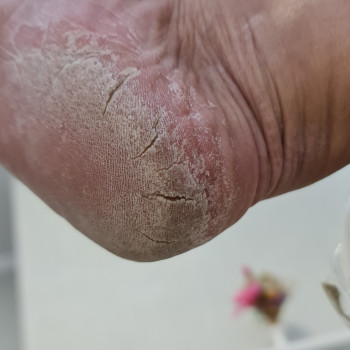 Педикюр аппаратный
                    Подолог Руслана Петровна Одесса