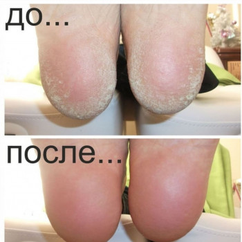 Педикюр аппаратный
                    Подолог Руслана Петровна Одесса