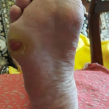 Педикюр аппаратный
                    Подолог Руслана Петровна Одесса