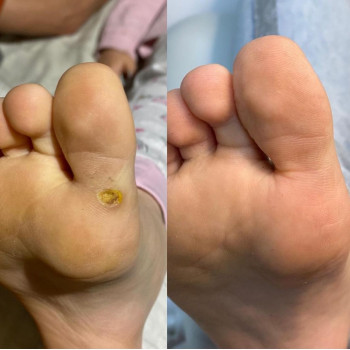 Педикюр аппаратный
                    Подолог Руслана Петровна Одесса