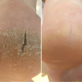 Мужской педикюр
                    Подолог Руслана Петровна Одеса