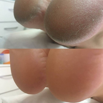 Мужской педикюр
                    Подолог Руслана Петровна Одеса