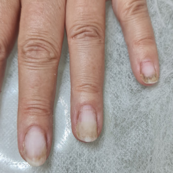 Лечение онихолизиса
                    Подолог Руслана Петровна Одеса