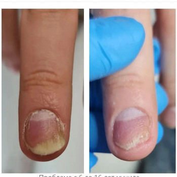 Лечение онихолизиса
                    Подолог Руслана Петровна Одеса