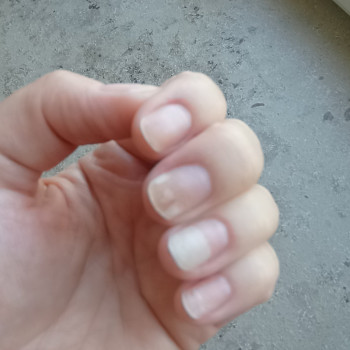 Лечение онихолизиса
                    Подолог Руслана Петровна Одеса