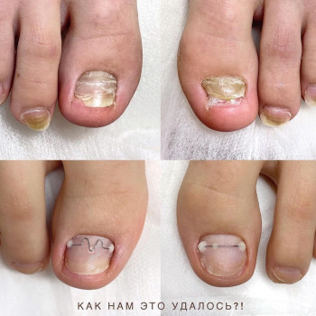 Лечение онихолизиса
                    Подолог Руслана Петровна Одеса