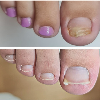 Лечение онихолизиса
                    Подолог Руслана Петровна Одеса