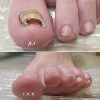 Лечение онихолизиса
                    Подолог Руслана Петровна Одеса