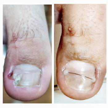 Установка титановой нити, скобы на ногти
                    Подолог Руслана Петровна Одеса