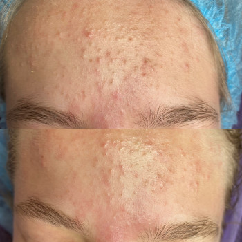 Мануальна чистка