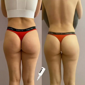 Результат курсу процедур Endospheres Therapy