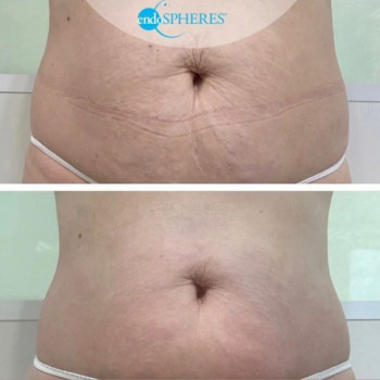 Результат курсу процедур Endospheres Therapy