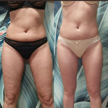 Результат курсу процедур Endospheres Therapy