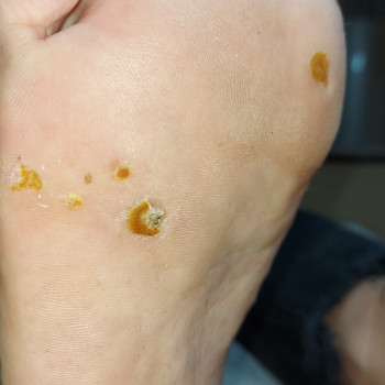 Лечение бородавки
                    Подолог Мария Одеса