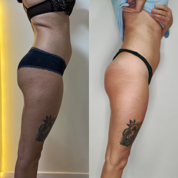 Результат курсу процедур Endospheres Therapy