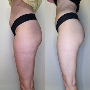 Результат курсу процедур Endospheres Therapy